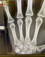 Jolanda Neff se fractura la mano en Leogang, a pesar de eso llegó cuarta