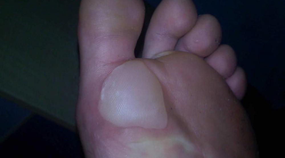 Ampollas en los pies que hacer Ampollas en los pies que hacer
