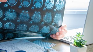 Guía rápida para detectar una conmoción cerebral