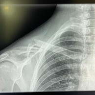 Rocío del Alba García se fractura la clavícula en Lenzerheide y será duda en las próxima pruebas de Copa del Mundo