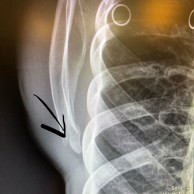 Annika Langvad se fractura la mano en una carrera local de MTB