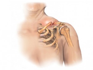 fractura-clvicula-300x225